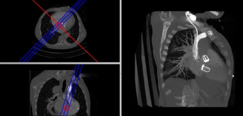 Серия компьютерных томограмм легких включая мультипланарную реконструкцию и 3 d изображение
